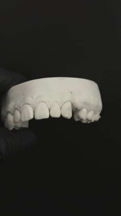 Missing Tooth (2 teeth minimum)